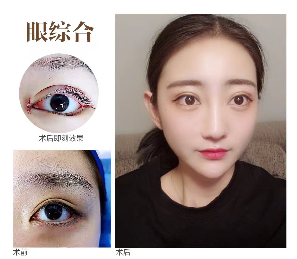 重睑成形术（双眼皮）