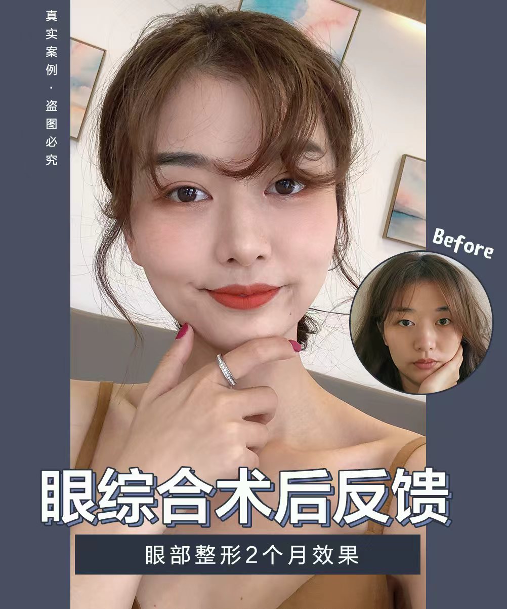 自体鼻综合整形
